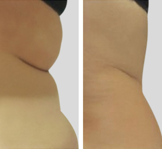 hips treatment results before and after