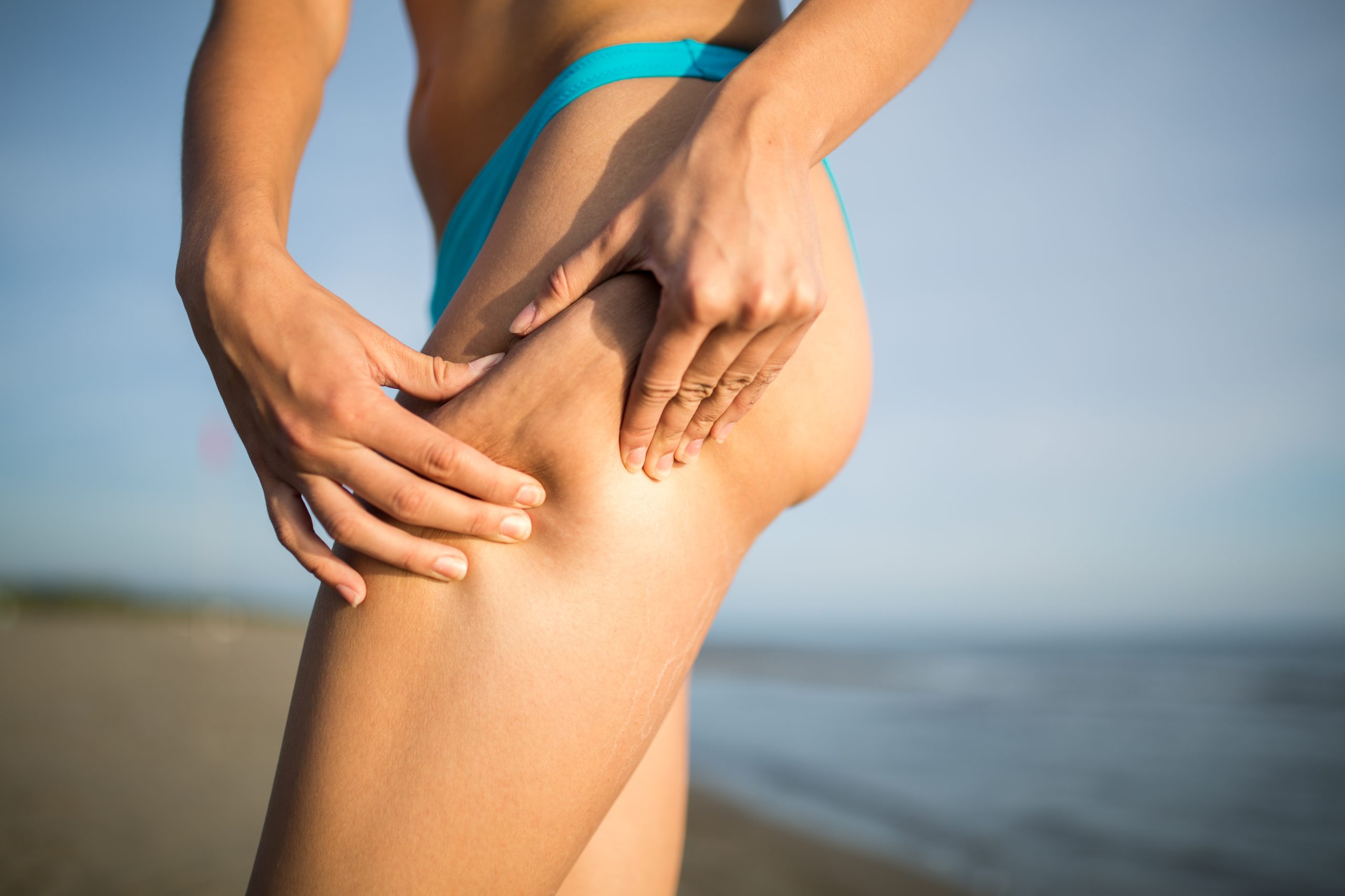 What causes cellulite?